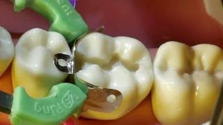 Composite Fill Walkthrough tutorial for 19 MO Approximal Box and Occlusal Fill [upl. by Marjana]