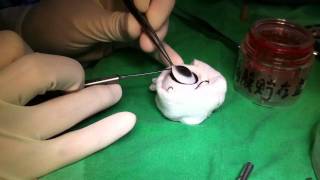 How to harvest cornea button [upl. by Mclain]