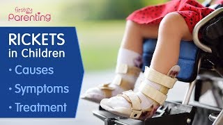 Rickets in Children  Causes Symptoms and Treatment [upl. by Lundgren939]