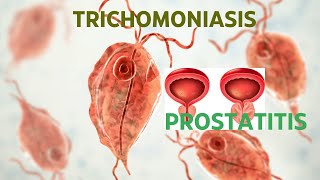 TRICHOMONIASIS ROLE IN PROSTATITIS [upl. by Sparhawk]