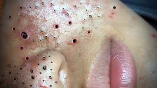 Relax Skincare Everyday with Acne Blackheads Treatment Spa 38089 [upl. by Elahcar]