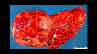 Patofisiologis Sirosis Hepatis [upl. by Noseyt389]