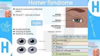 Horner SyndromeClinical manifestations diagnosis and management [upl. by Tigram]