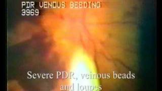 VideoDocumentation of Retinal Diseases [upl. by Lennon423]