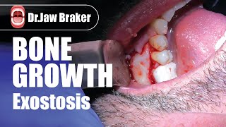 Exostosis  Bone Growth [upl. by Jedthus868]