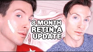 MY FIRST 8 MONTHS ON RETINA Before and After Results [upl. by Ettenan348]