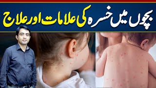 Measles Symptoms amp Treatment  Measles Treatment For Babies  Khasra Ki alamat Aur ilaj [upl. by Allcot]