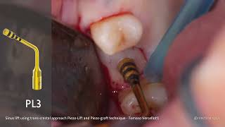 PIEZOSURGERY®  Prof Tomaso Vercellotti  Sinus lift using a transcrestal approach [upl. by Gabe350]