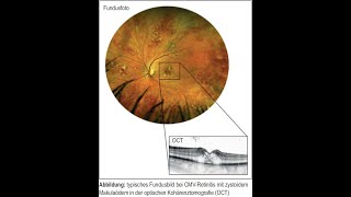 CMV Retinitis bei unerkanntem Immundefektsyndrom [upl. by Anifares]