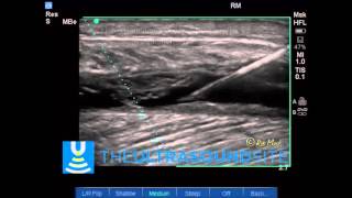 Ultrasound of Torn Gastrocnemius Muscle with Haematoma and USG aspiration [upl. by Valerye232]