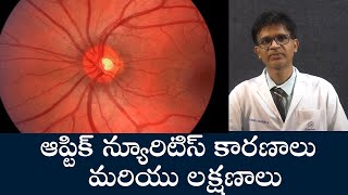 Causes and Symptoms of Optic Neuritis  ఆప్టిక్ న్యూరిటిస్ కారణాలు మరియు లక్షణాలు  Samayam Telugu [upl. by Ettenom]