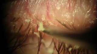 Demodex Blepharitis Plaque Removal with Forceps  Eyelash Mite at 539 [upl. by Kassandra523]