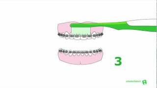 Igiene e pulizia ortodonzia fissa [upl. by Rivalee]