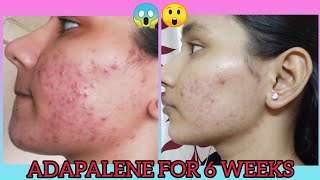 I USED ADAPALENE FOR 6 WEEKS AND THIS HAPPENED😱🤯 MY EXPERIENCE HOW TO USE KHUSHI MAHLA [upl. by Emilia556]