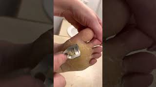 Feet Shaving Ball of Foot  Jan 12 2023  Diffuse Epidermolytic Palmoplantar Keratoderma [upl. by Ardme193]