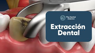 Retira una Muela del Juicio con una Extracción Dental  The Dental District [upl. by Oirromed]