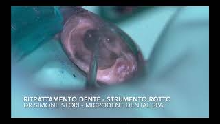 Endodonzia Bologna  Ritrattamento Canalare con Rimozione Strumento Rotto [upl. by Belcher]