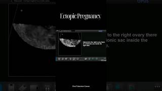 Ectopic Pregnancy [upl. by Notsruht421]