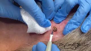 REMOVAL OF A SQUAMOUS CELL CANCER FROM BEHIND THE EAR [upl. by Limbert705]