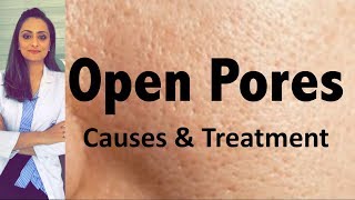 Open Pores Causes amp Treatment  Dermatologists opinion  Dr Aanchal Panth [upl. by Randolph343]