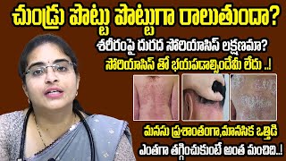 How to Prevent Psoriasis  Skin infection  Scalp Psoriasis Treatment  Medi9 Homeopathy Ayurveda [upl. by Natsreik]