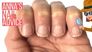 RIDGY NAILS THE COSMETIC SOLUTION ANNAS NAIL ADVICE [upl. by Htieh]