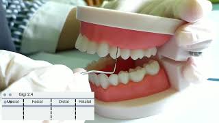 Cara Pemeriksaan Gingival Index [upl. by Romilly]