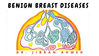 BENIGN BREAST DISEASE [upl. by Jamin]