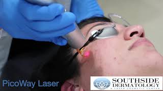 PicoWay Laser Treatment for Acne Scars amp Dark Spots [upl. by Araec]