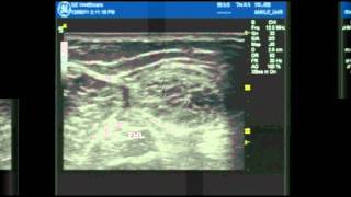 Ultrasound Guided ankle block part 1 [upl. by Raynard]