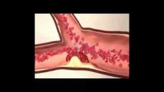 Trombus Formation and Fibrinolysis [upl. by Anawak]