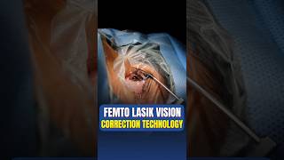 Live Femto Lasik Vision Correction Surgery [upl. by Oriaj196]