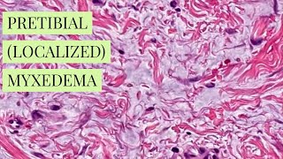 Pretibial localized myxedema explained by a dermatopathologist unknown 12 dermpathiseasy [upl. by Notyalc]