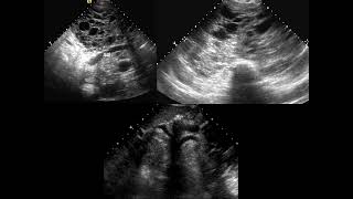 Chest FRCR2b CASES [upl. by Ahsirahc]