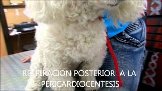 PERICARDIOCENTESIS  CITOLOGIA CON CELULAS NEOPLASICAS [upl. by Giwdul]