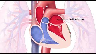 Mitral Valve Regurgitation [upl. by Mehala]