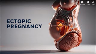 First Trimester Ectopic Pregnancy [upl. by Pol875]