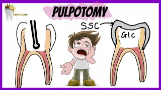 PEDIATRIC DENTISTRY  PULPOTOMY  Types Indications Procedure [upl. by Daiz]