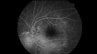 FRG Angiografía de Retina Fluoresceinografía Retinografia angiofluoresceinografía [upl. by Somisareg]