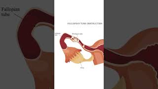 Does TB Tuberculosis Affect Fertility  Dr Kavya Krishnappa [upl. by Augy]