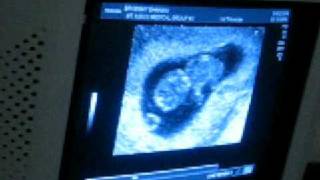 9 weeks 4 days Ultrasound [upl. by Mclaurin]