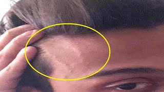 how to make veins pop out of your forehead [upl. by Illah]