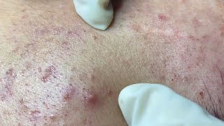 Acne treatment for Spa Linh Mun 2023 103 [upl. by Sakmar]