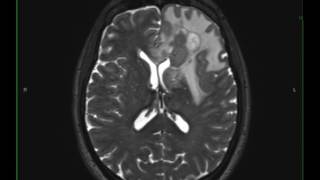 Grade 3 Anaplastic Astrocytoma [upl. by Anilat]