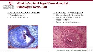 Cardiac Allograft Vasculopathy CAV  Weekly Research Conference with Sharon Chih MD PhD [upl. by Caralie]