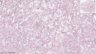 Pneumocystis Jirovecii Pneumonia  Histopathology [upl. by Yartnod881]