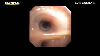 Routine and Slim Design True Videobronchoscopes [upl. by Jennings]