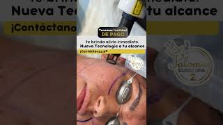 Láser para Cicatriz de Acné acne laseracne acnescars [upl. by Olvan]