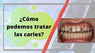 ¿Qué tratamientos hay para las caries  Dr Alvaro Campos [upl. by Heath]