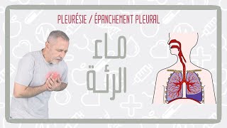 تدويزة  الماء فالرئة TEDWIZA  Pleurésie  épanchement pleural [upl. by Trebleht949]